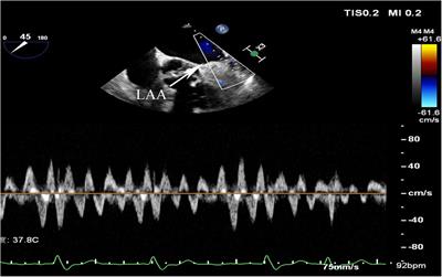 Influencing factors and predictive model for left atrial appendage emptying velocity in nonvalvular AF patients